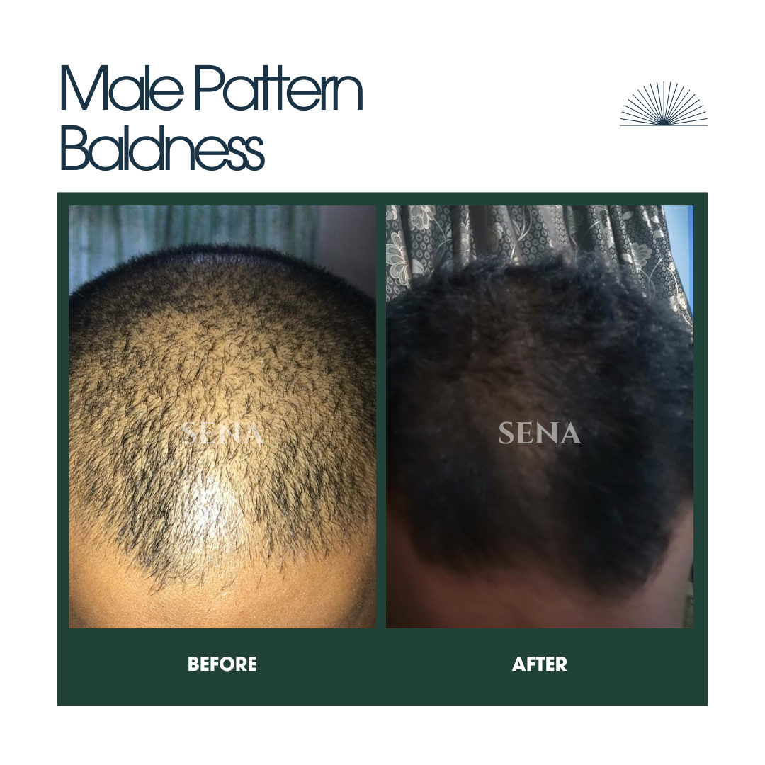 RootVeda Oil | Natural Hair Oil for Hair Fall & Scalp Nourishment