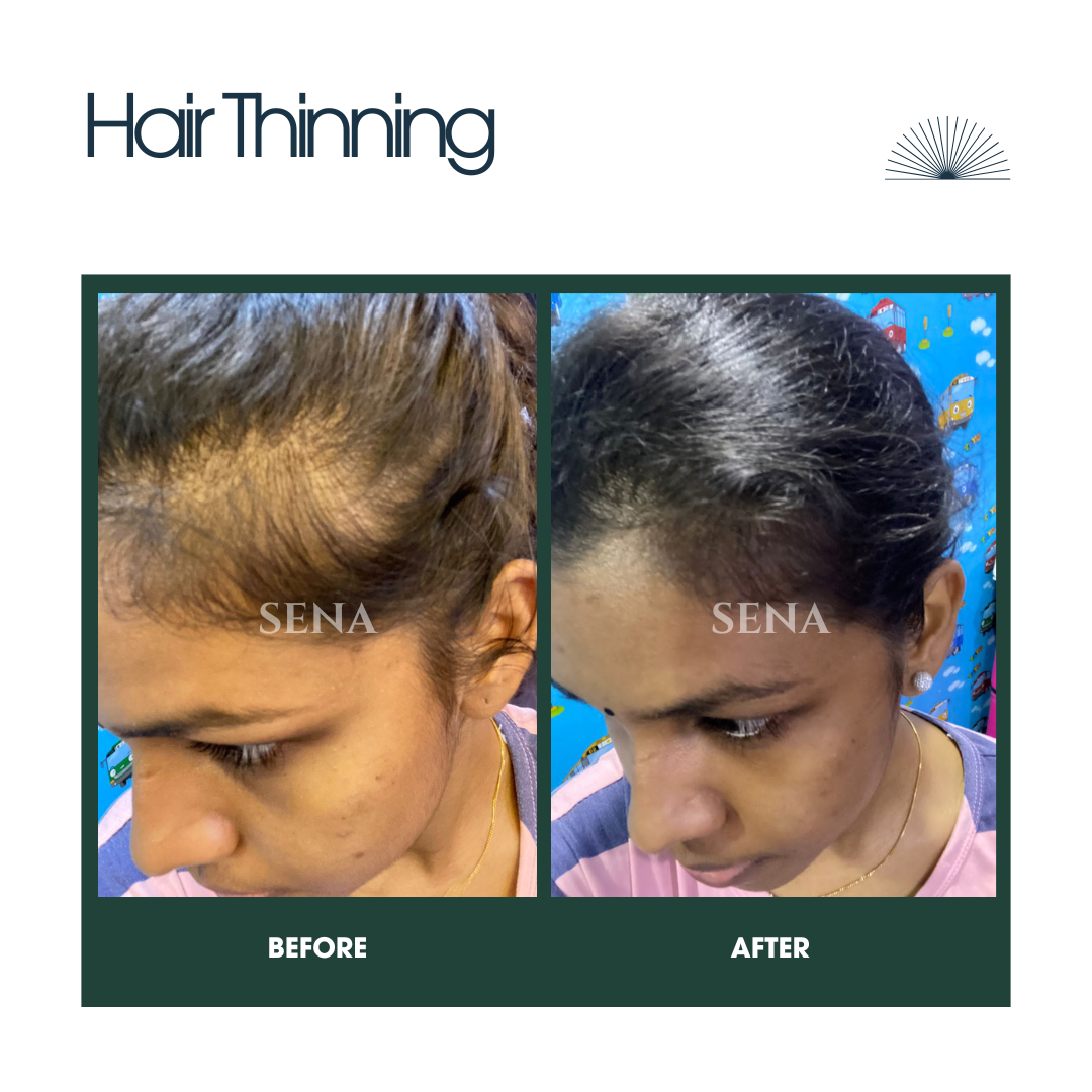 Ultimate Hair Regrowth System (4-Step)